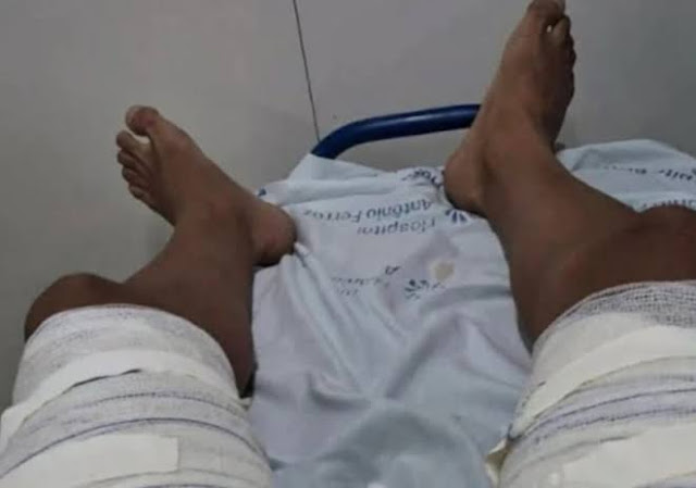 Urgente/Macau: Polícia Civil conclui investigação de caso em que mulher jogou água fervente em ex-companheiro